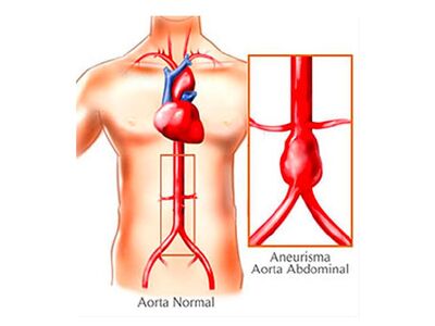 Aneurisma de Aorta