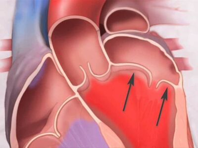 Prolapso Mitral