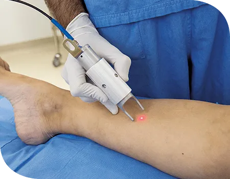 Cirurgia a laser para varizes